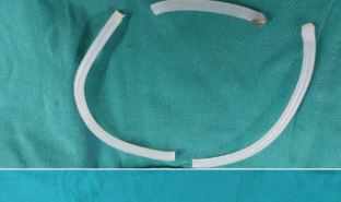 Gặp hoạ vì nhét keo nến dài 40cm vào niệu đạo để tự sướng