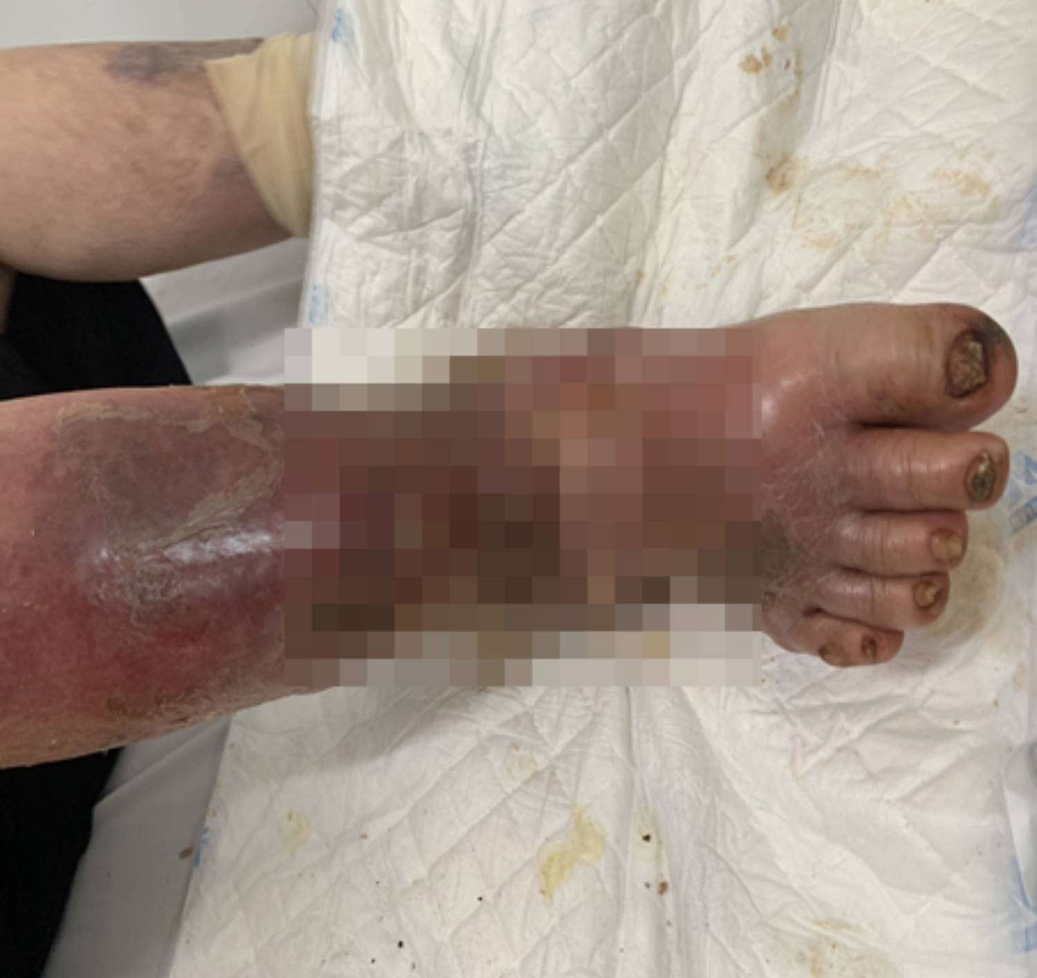 Bệnh nhân đái tháo đường nguy kịch do thường xuyên sử dụng thuốc giảm đau