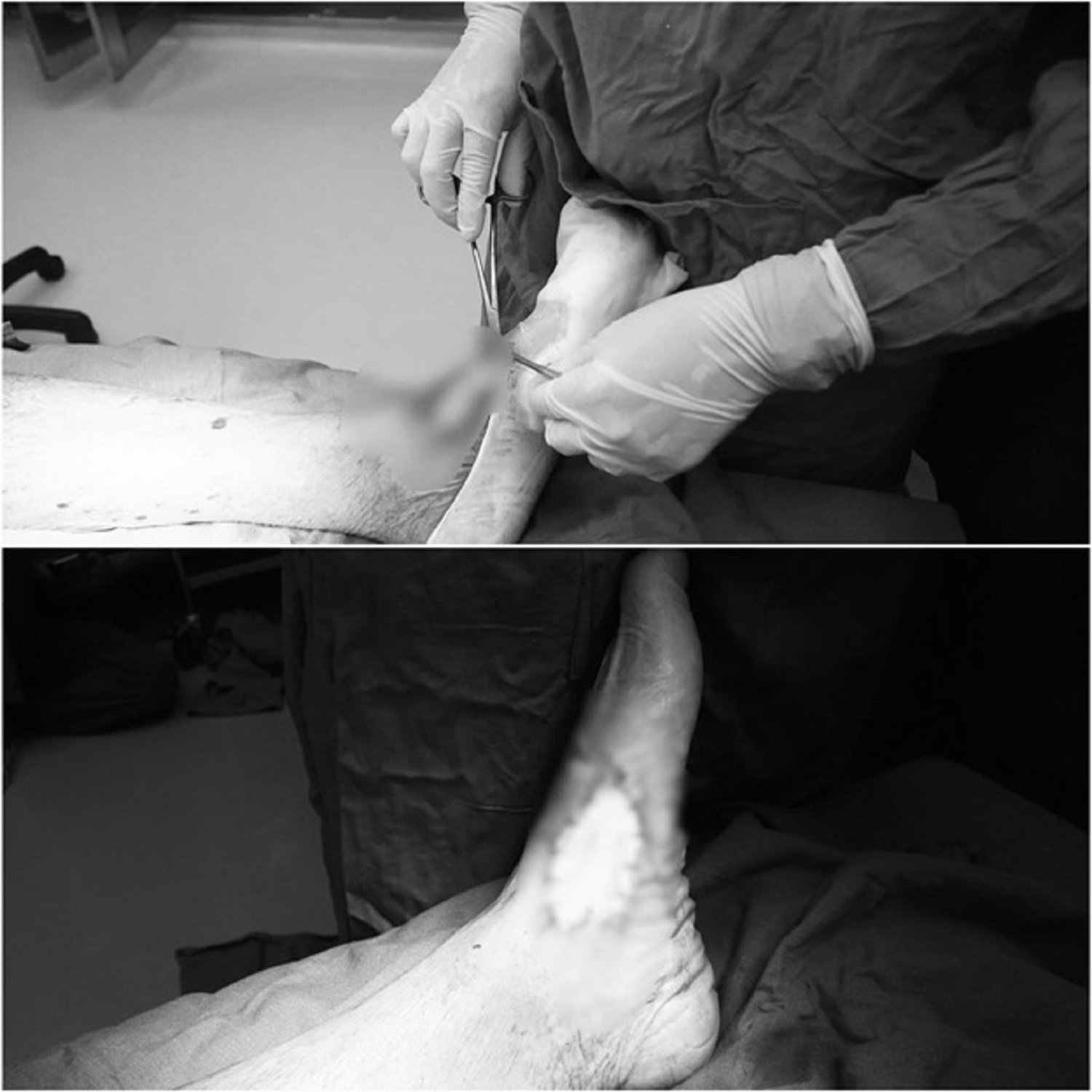 Tự đắp lá cây trị vết thương tại nhà bị nhiễm trùng nguy kịch
